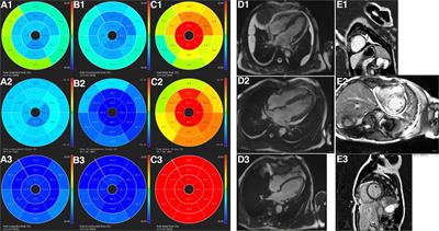 Layer-specific strain in patients with cardiac amyloidosis using tissue tracking MR